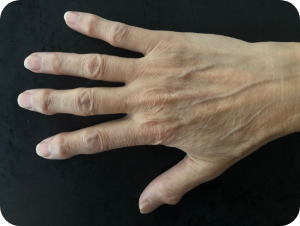 Dr Alain tchurukdichian - l’arthrose des doigts longs