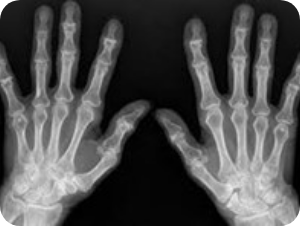 Dr Alain tchurukdichian - l’arthrose des doigts longs