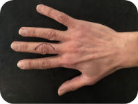 L'arthrose des doigts longs